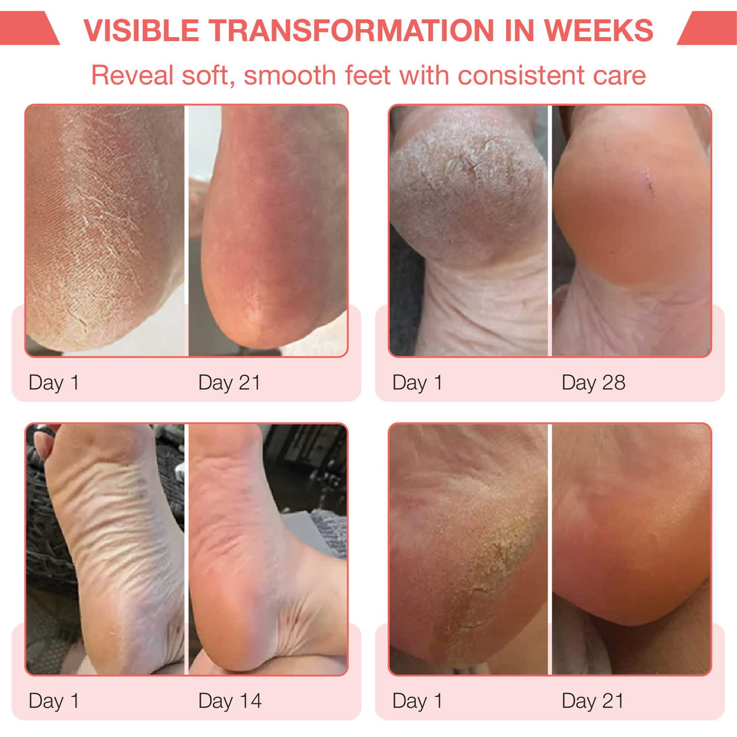 SelinaPro™ ProCare Elite Electric Foot Callus Remover
